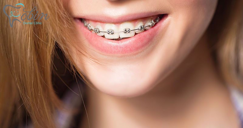احساس لق شدن دندان ها بعد از ارتودنسی، یکی از اتفاقاتی است که بعد از ارتودنسی ممکن است اتفاق بیفتد.